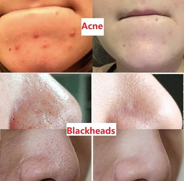 Buy 1 GET 1 FREE! Dystar Green Tea Deep Cleanse Mask Stick + Free Shipping